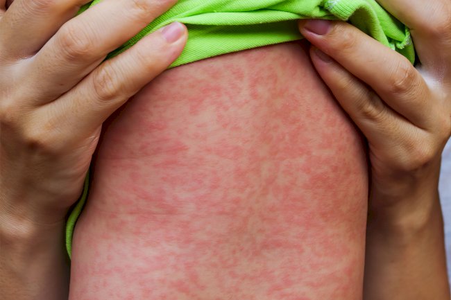 Belçika’da Türk ailelere çağrı: Çocuklara kızamık aşısı daha erken yapılacak